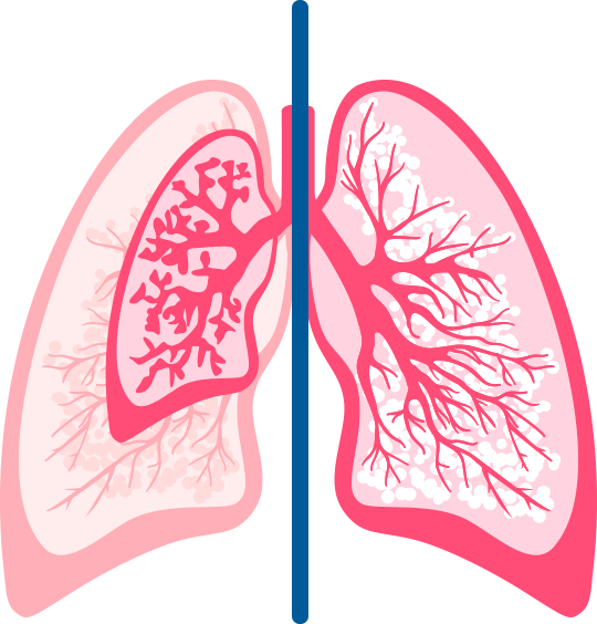 Preterm versus Full Term Lungs2