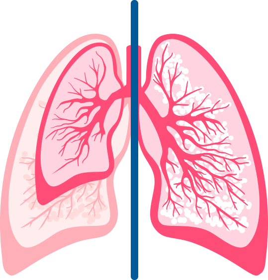 Preterm versus Full Term Lungs 3